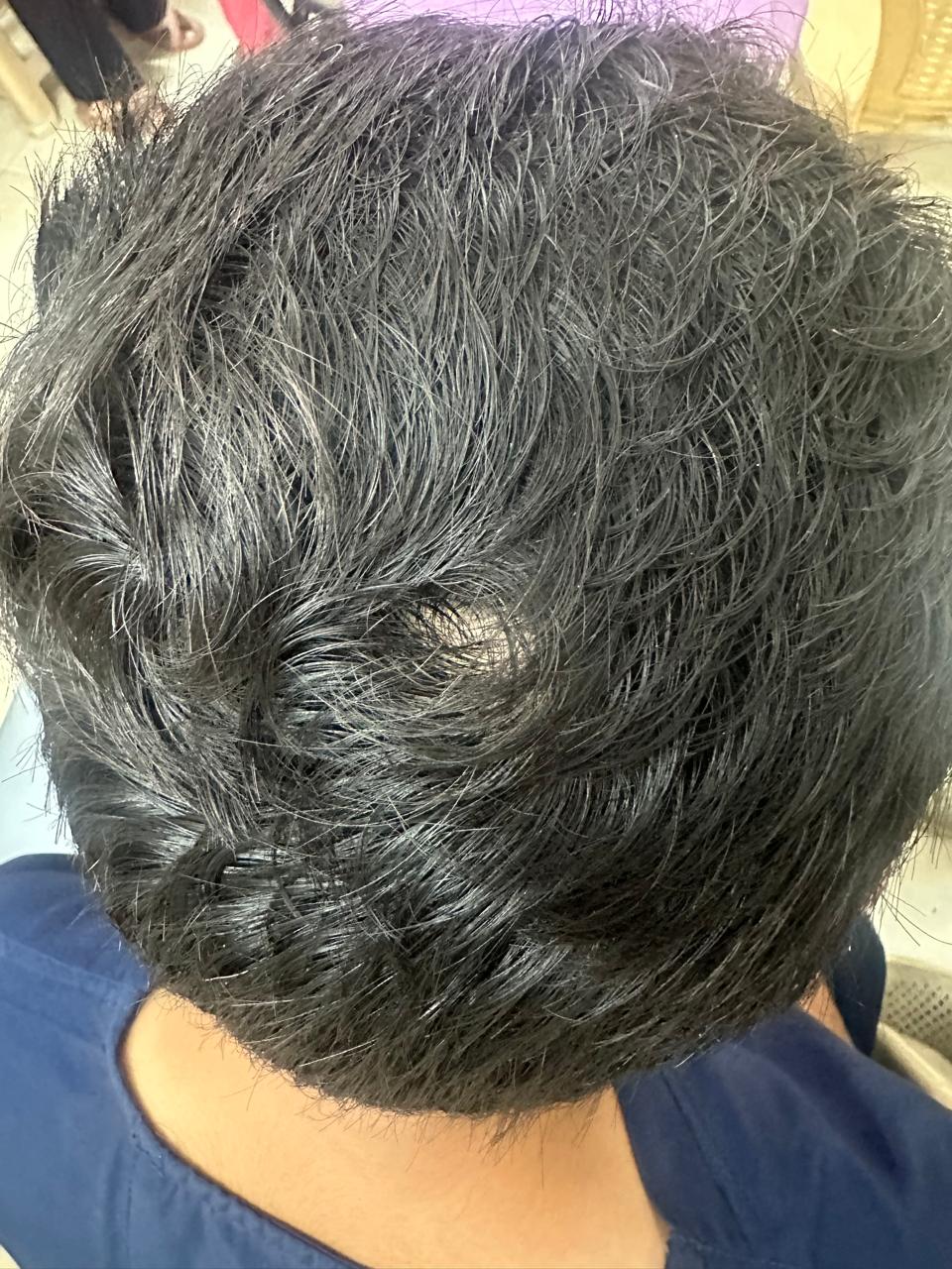Hair Restoration Success — after treatment