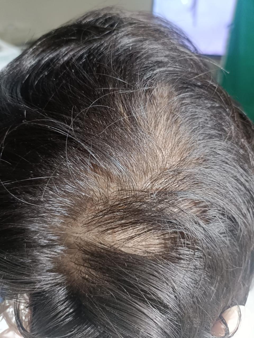 Hair Restoration Success — before treatment