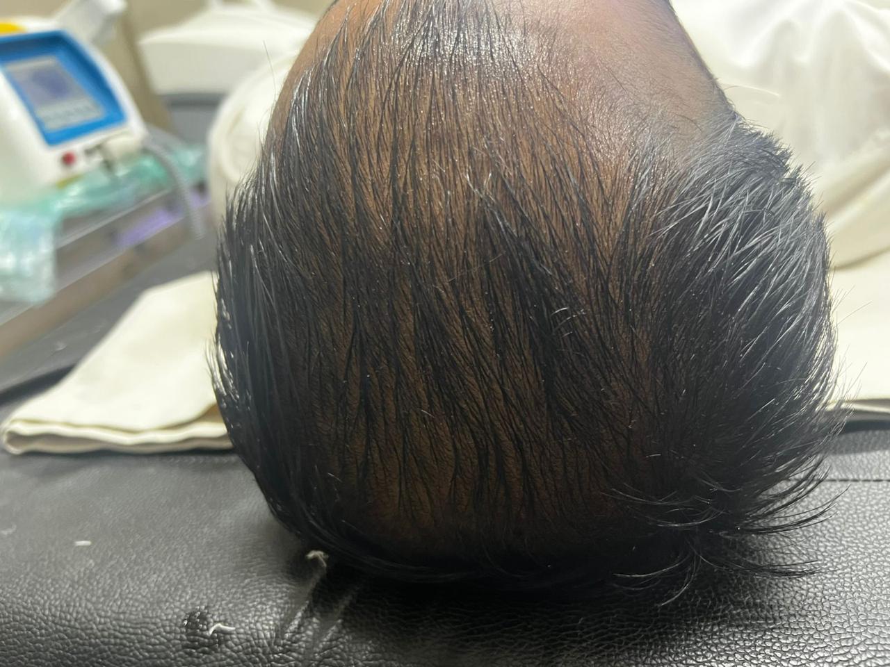 Hair Density Restoration — before treatment
