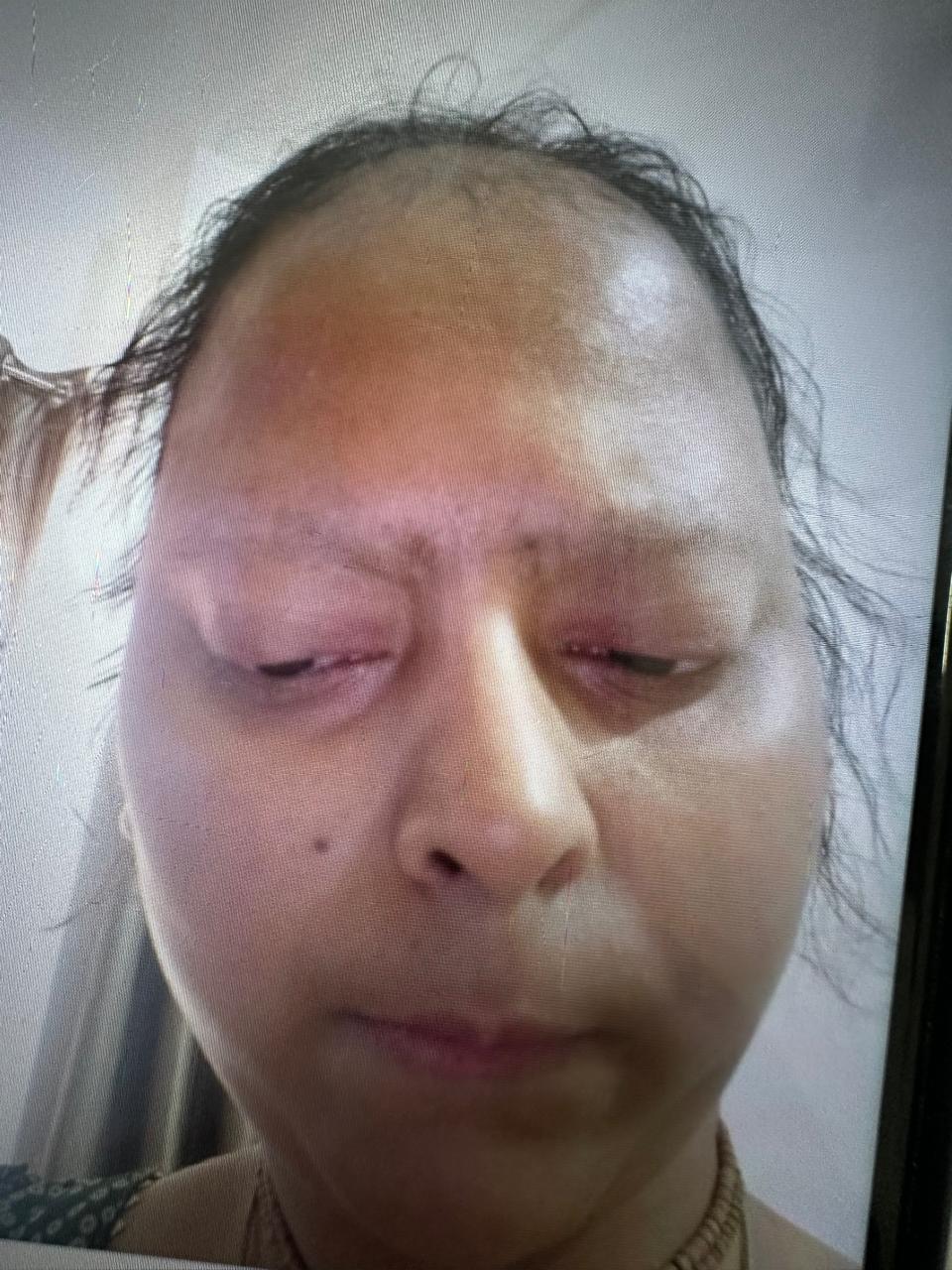 Crown Reconstruction — before treatment